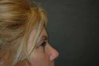 Eyelid Lift