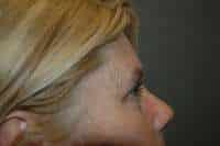 Eyelid Lift