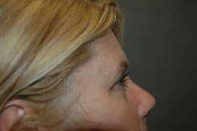 Eyelid Lift