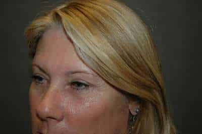 Eyelid Lift