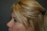 Eyelid Lift