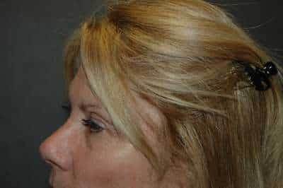Eyelid Lift