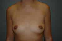 Breast Augmentation