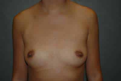 Breast Augmentation