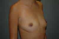 Breast Augmentation