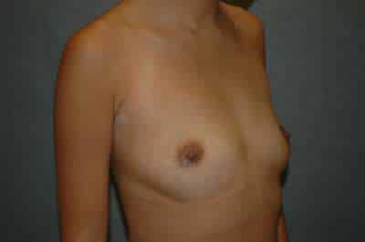 Breast Augmentation