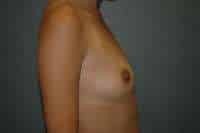 Breast Augmentation