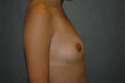 Breast Augmentation