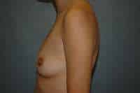 Breast Augmentation