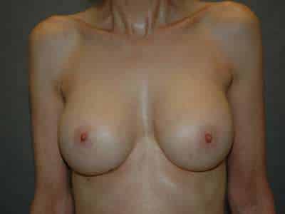 Breast Augmentation