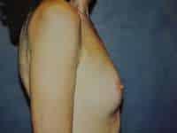 Breast Augmentation