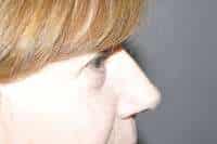 Eyelid Lift