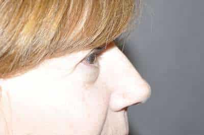 Eyelid Lift