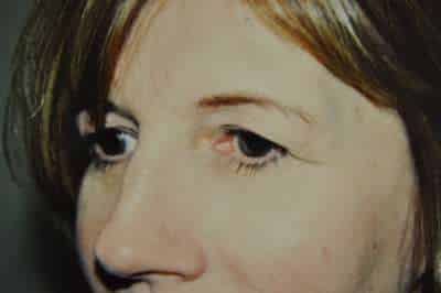 Eyelid Lift