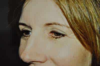 Eyelid Lift