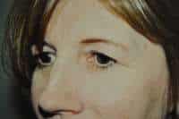 Eyelid Lift