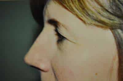 Eyelid Lift