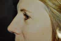 Eyelid Lift
