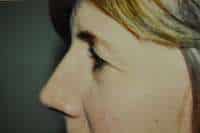 Eyelid Lift