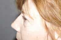 Eyelid Lift