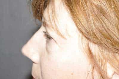 Eyelid Lift