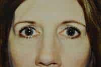 Eyelid Lift