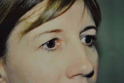 Eyelid Lift