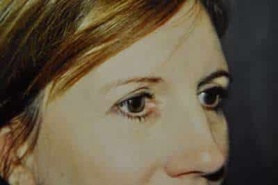Eyelid Lift