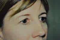 Eyelid Lift