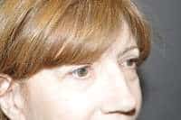 Eyelid Lift