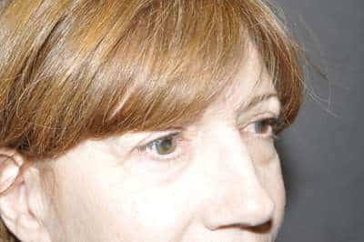 Eyelid Lift