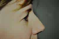 Eyelid Lift
