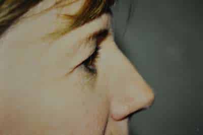 Eyelid Lift