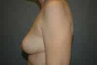 Breast Lift