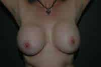 Breast Lift
