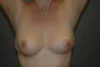Breast Lift