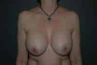 Breast Lift