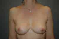 Breast Lift