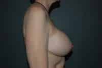 Breast Lift
