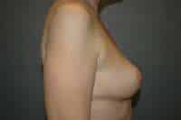 Breast Lift