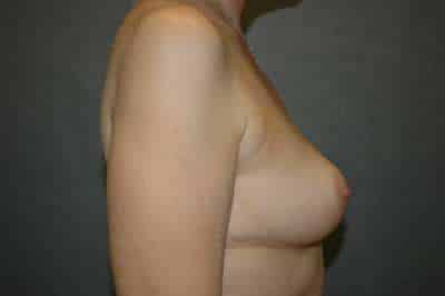 Breast Lift