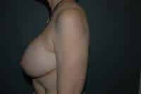Breast Lift