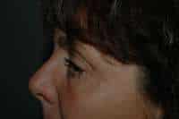 Eyelid Lift