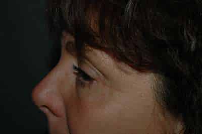 Eyelid Lift