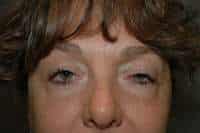 Eyelid Lift