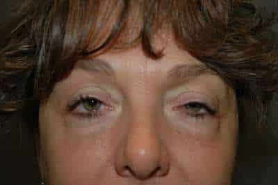 Eyelid Lift
