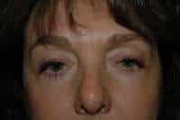 Eyelid Lift