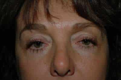 Eyelid Lift