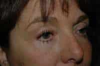 Eyelid Lift