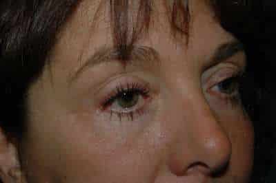 Eyelid Lift